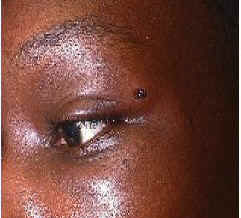 Clinical image of eyelid trauma caused by a foreign object (BB).